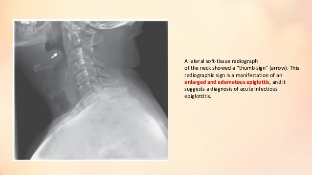 thumb sign epiglotitis Thumb sign epiglotitis